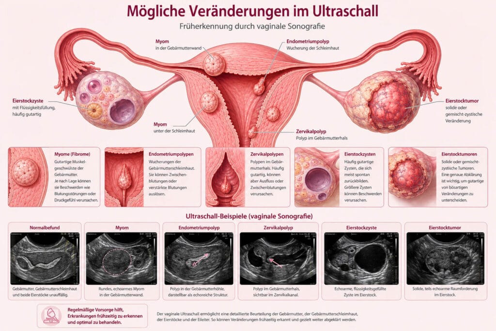 Vaginalultraschall Infoposter